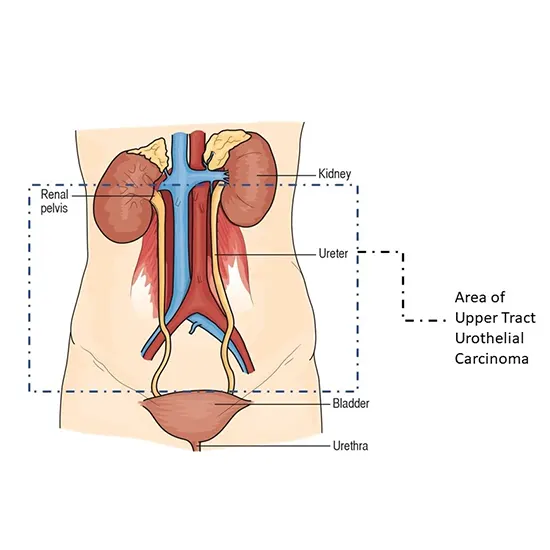 ureter and renal pelvis cancer package test